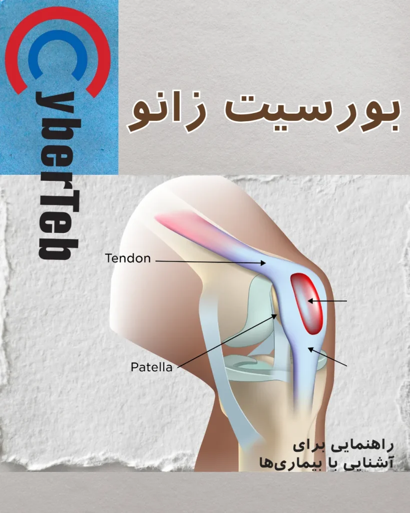 بورسیت زانو