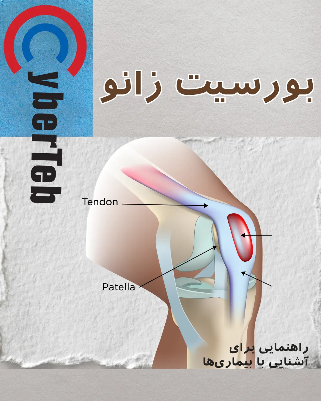 بورسیت زانو