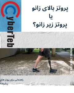 پروتز بالای زانو