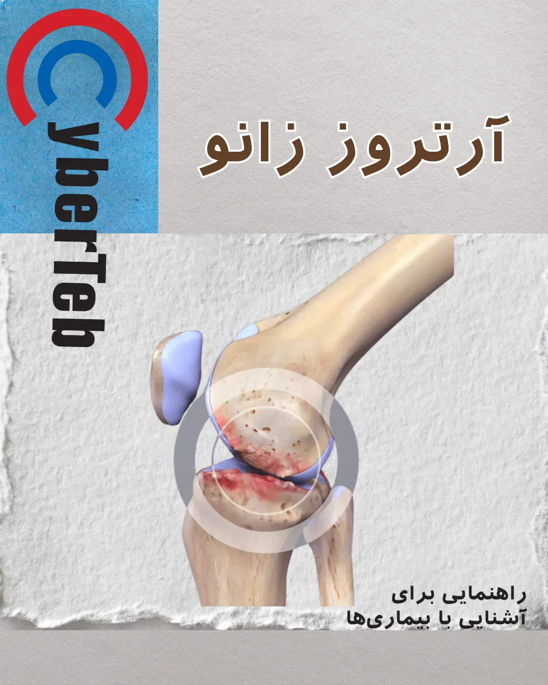 آرتروز زانو