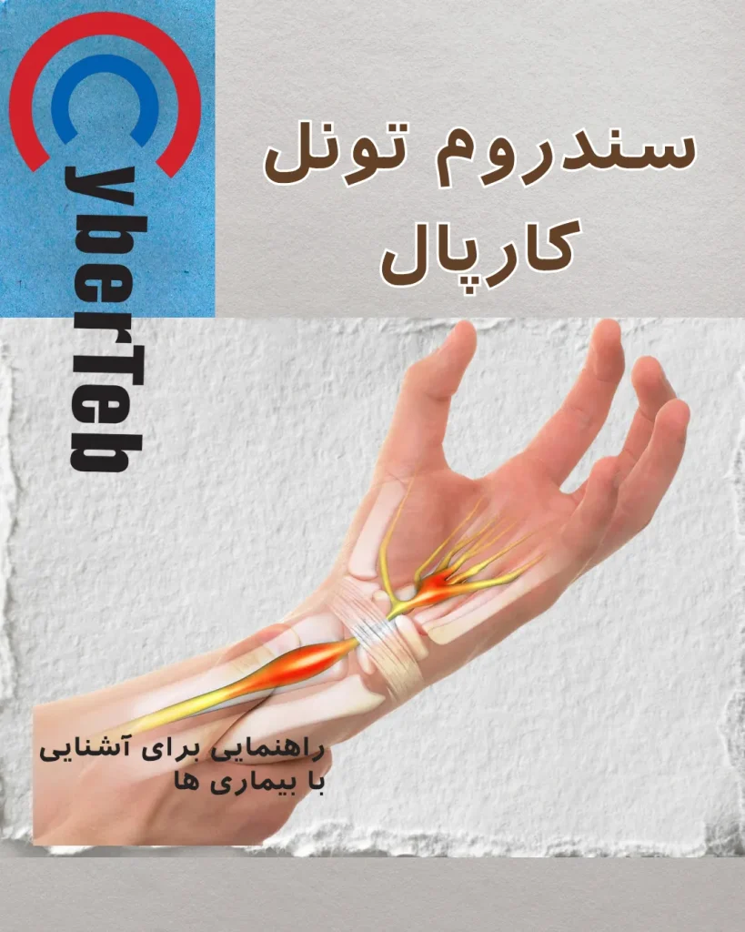 سندروم تونل کارپال